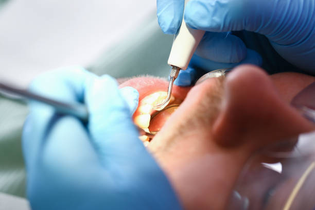 Best Emergency Root Canal Treatment in Somerset, OH