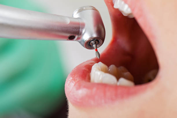 Best Emergency Tooth Extraction in Somerset, OH